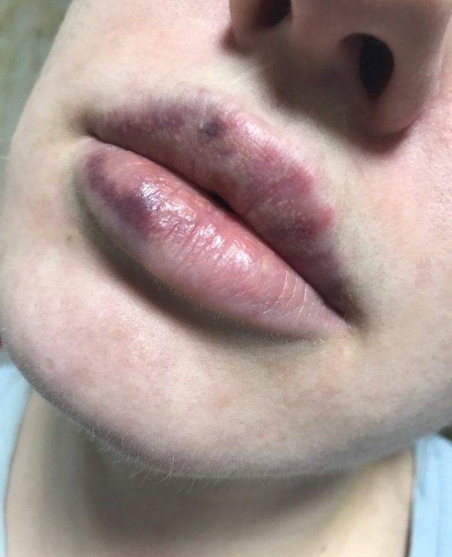 Ecchymoses après augmentation des lèvres